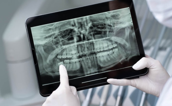 Radiografia de siso